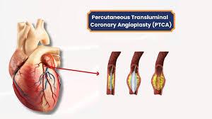 angioplasty-ptca