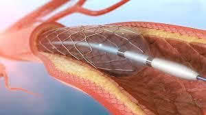angioplasty-with-stent