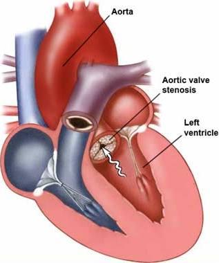 avr-mvr-tissue-implant