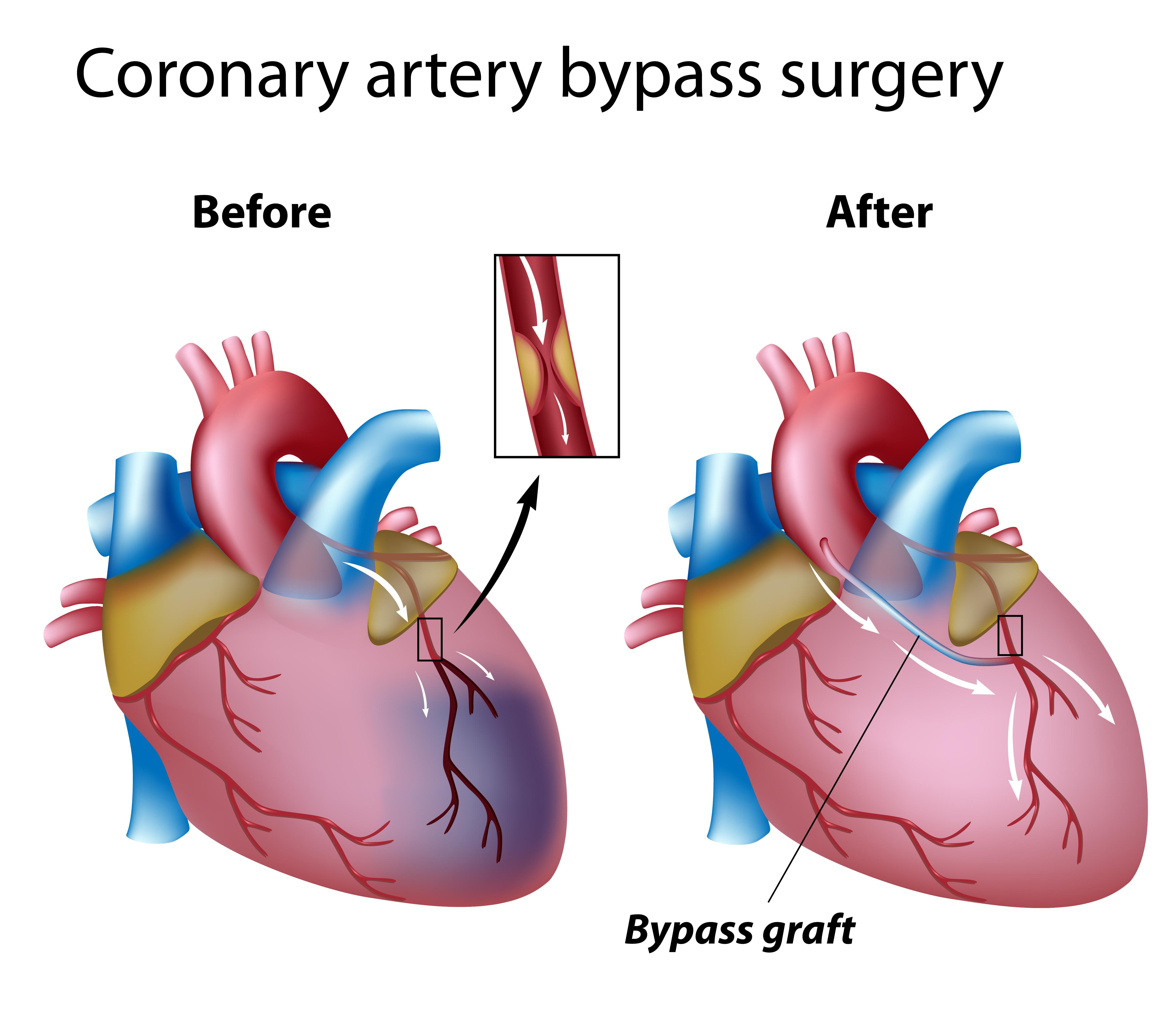 cabg-avr-tbrepair-iabp