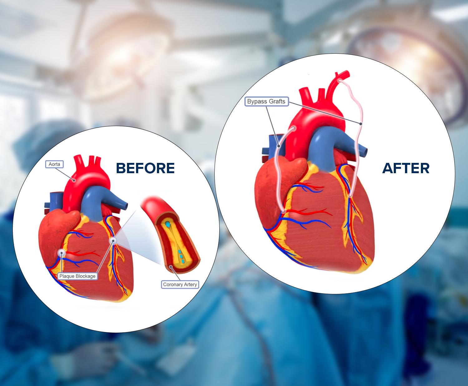 cabg