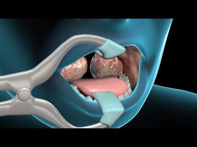 coablation-assisted-adenotonsillectomy