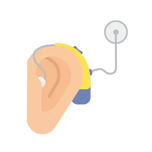 cochlear-implantation