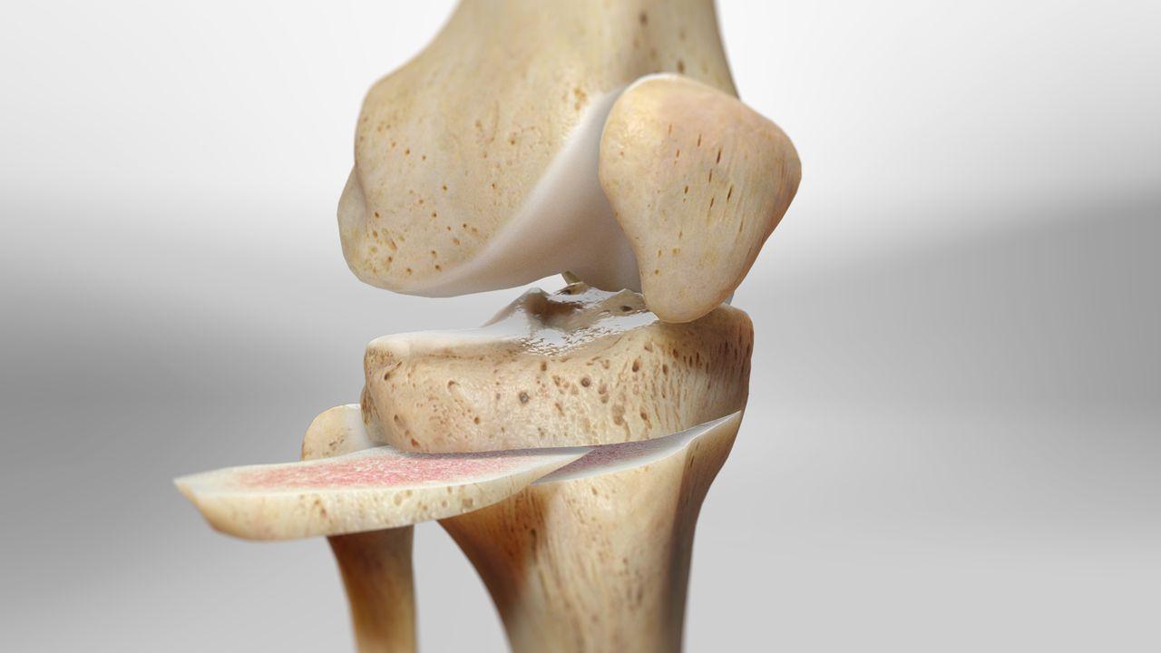 corrective-osteotomy-tibia-with-bone-grafting