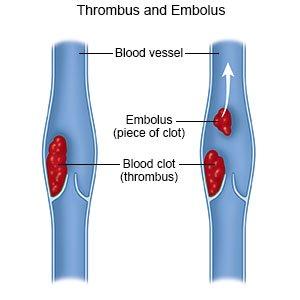 embolectomy