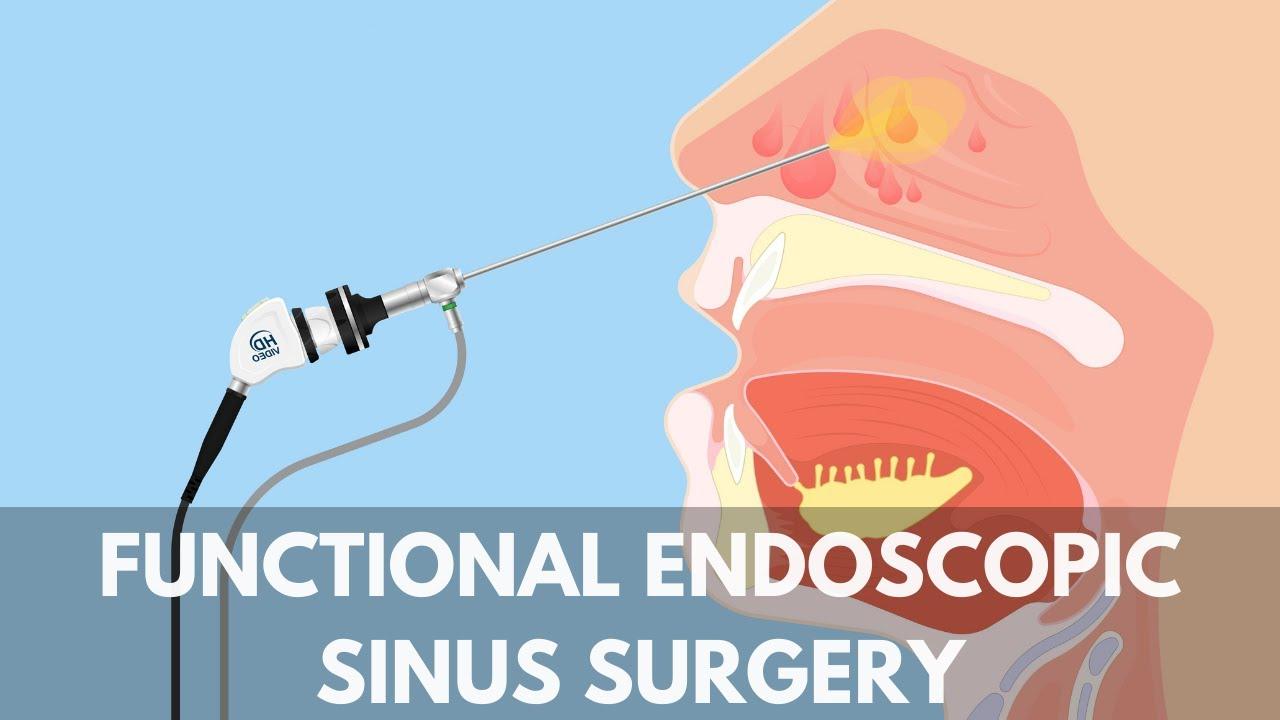 endoscopic-sinus-surgery