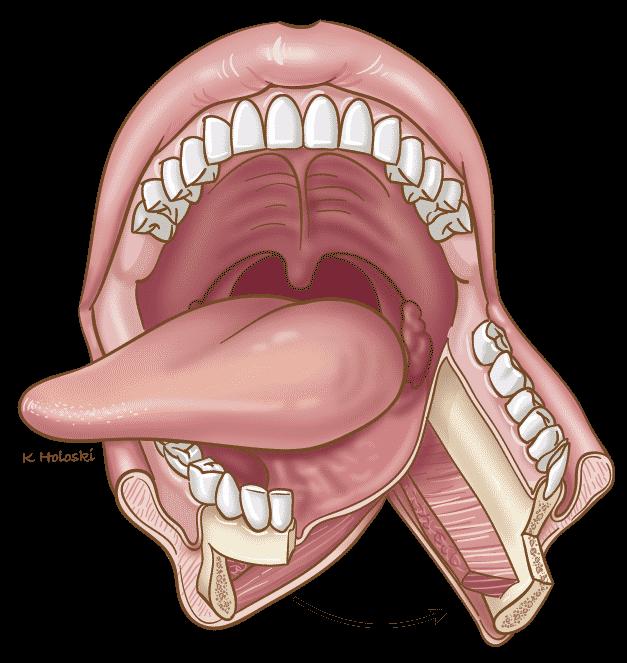 glosssectomy-total