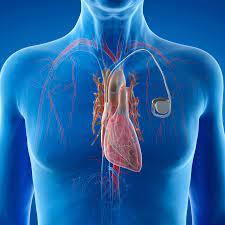 permanent-pacemaker-insertion