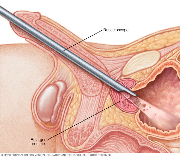 prostate-removal-turp