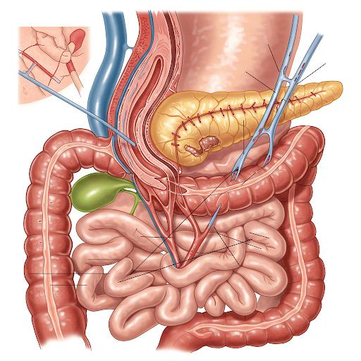 whipple-procedure-lap