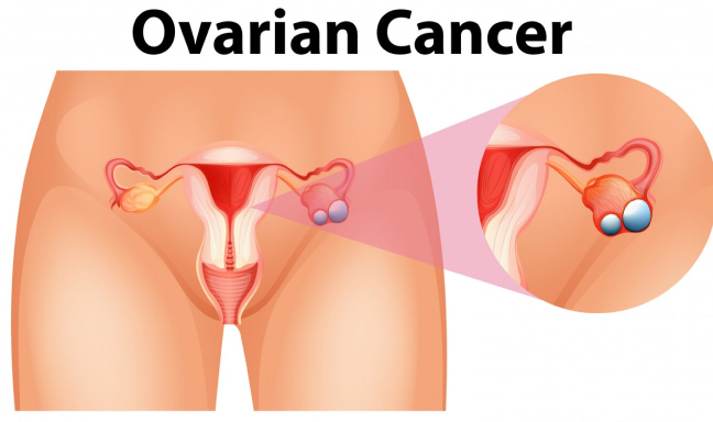 Ovarian-Cancer-Treatment