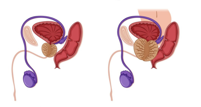 Prostate-Cancer-Treatment