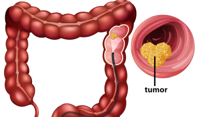 colone-cancer-treatment