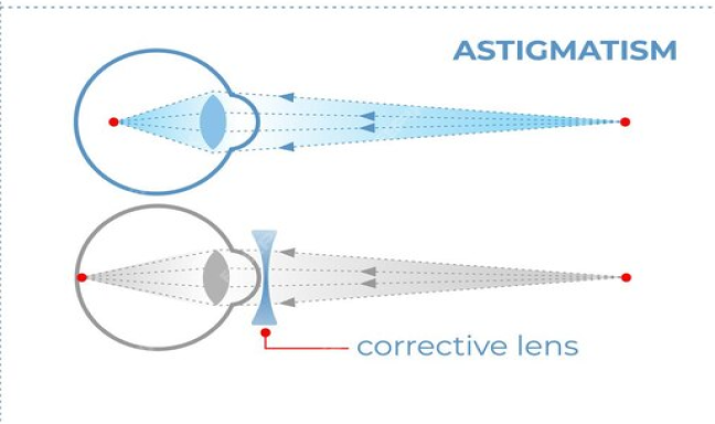 Astigmatism-Treatment
