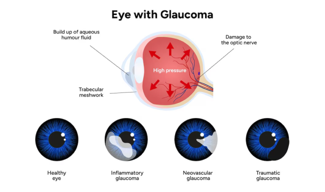 LASIK-Treatment