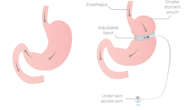 Gastric-Banding-Surgery