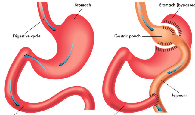 Gastric-Bypass