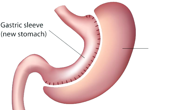 Gastric-Sleeve-Surgery