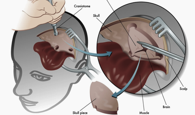 Anal-Cancer-Treatment